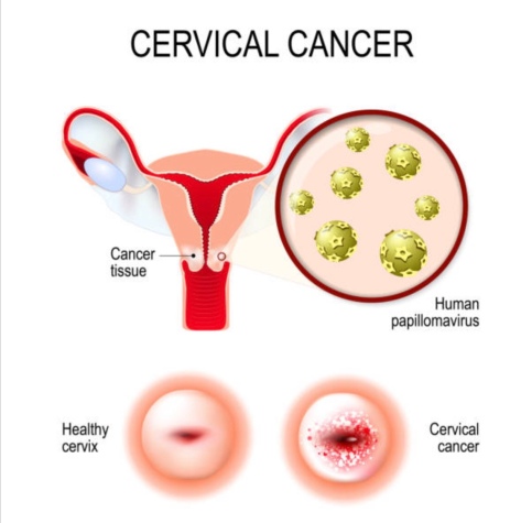 Ministry Of Public Health Cervical Cancer Screening Campaign